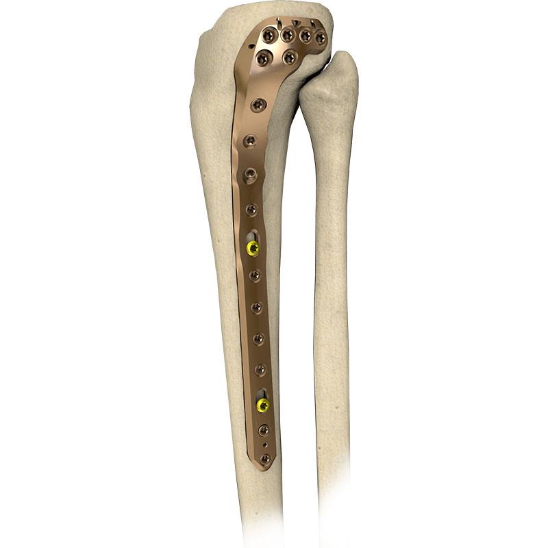 Пластина великогомілкова проксимальна латеральна L-подібна 5,0ChLP
